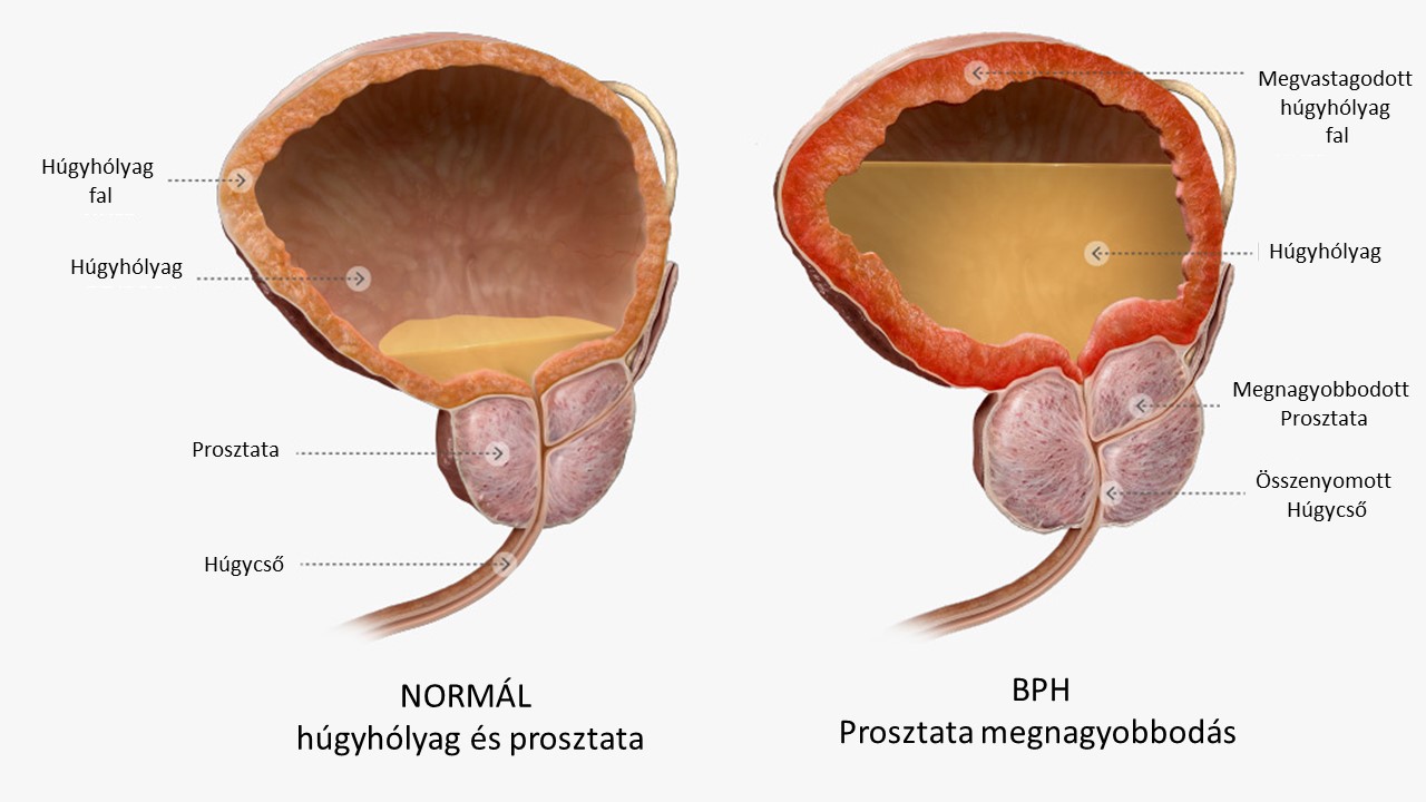 A benignus prostata hyperplasia gyógyszeres kezelése