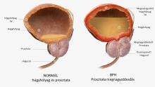 prosztata műtét